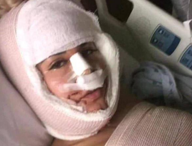 女子花重金整容,一年经历13次整容手术,整容前后判若两人