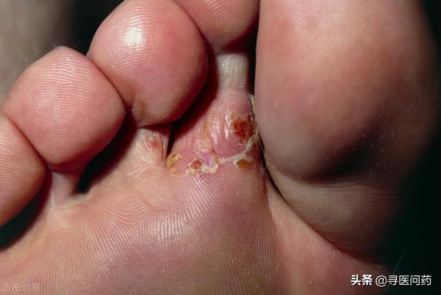 女性注意:私处老是瘙痒,或是感染了脚气