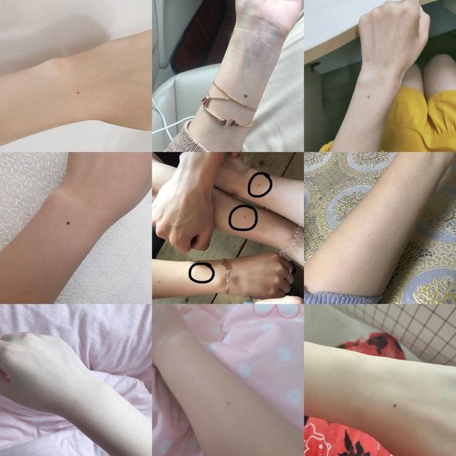 很多人“手臂中间有颗痣”,其实是胎记痣,可能在胎儿期就已注定