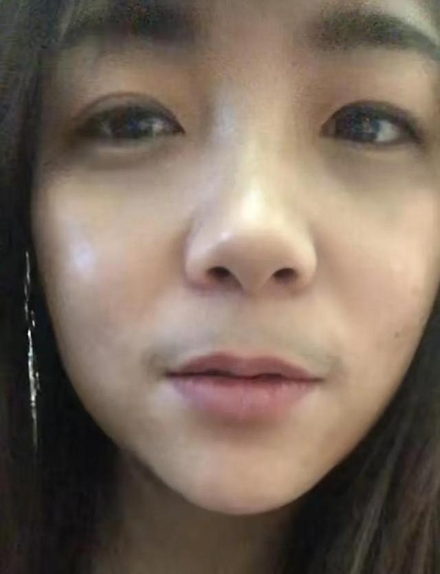 女子感染新冠烧退了,却长出了胡子,前后判若两人