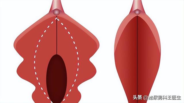 查出阴道肥大,严重吗?到底是咋回事?需不需要治疗?