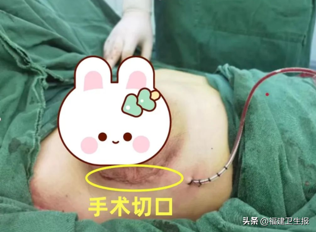 警惕!漳州16岁女孩一侧乳房像吹气球一样疯长!去医院才发现……